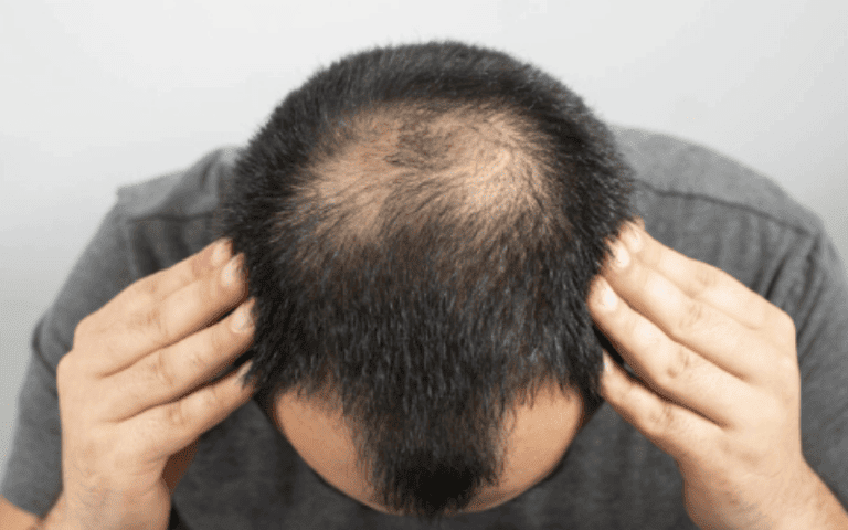 Estresse pode causar perda de 50 do cabelo especialista da dicas para tratar