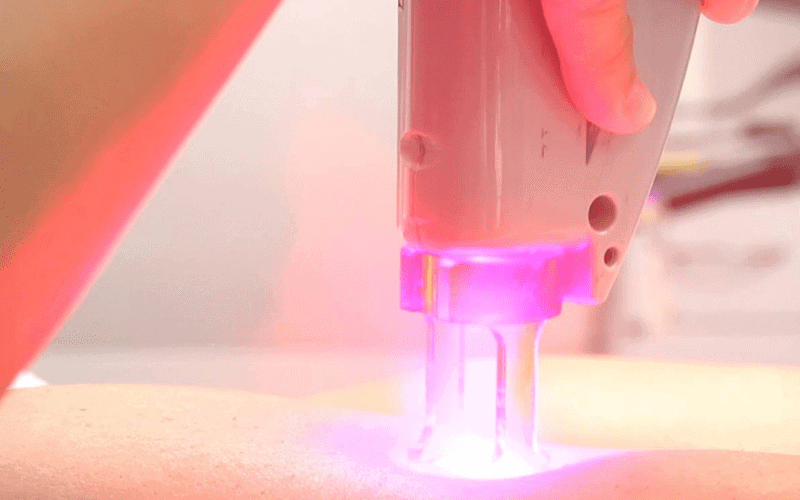 Como funciona a depilacao a laser