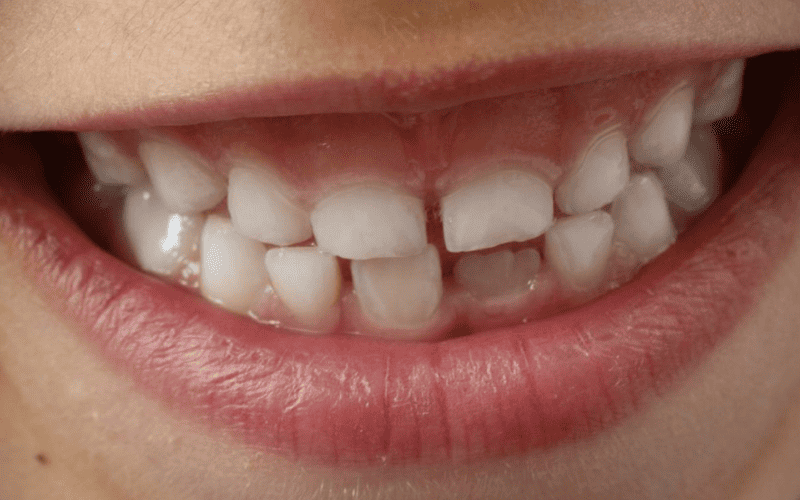 Por que os dentes nao se regeneram