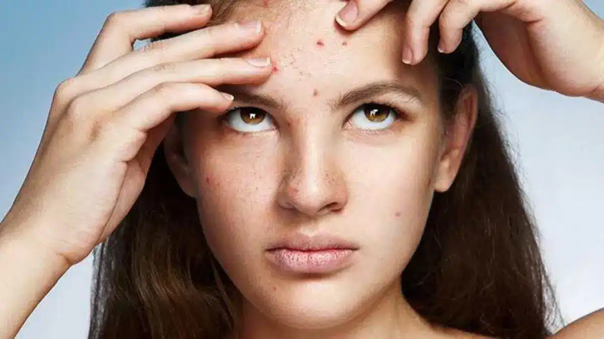 O impacto psicologico da acne na adolescencia