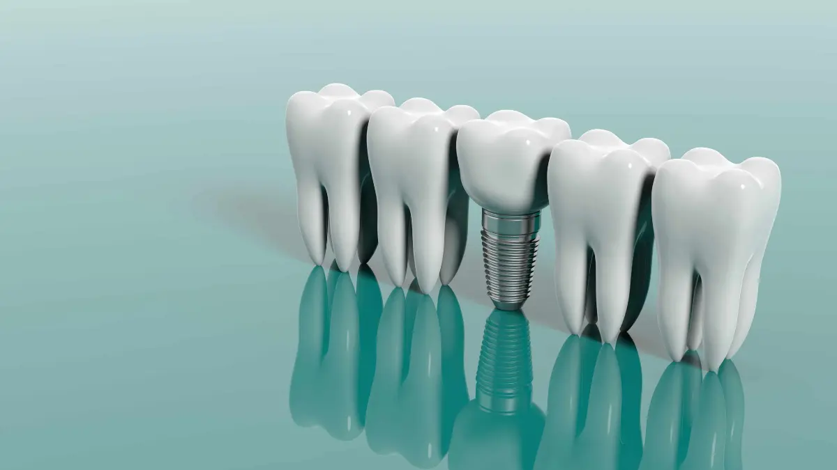 Para que sao utilizados implantes dentarios e para que sao utilizados