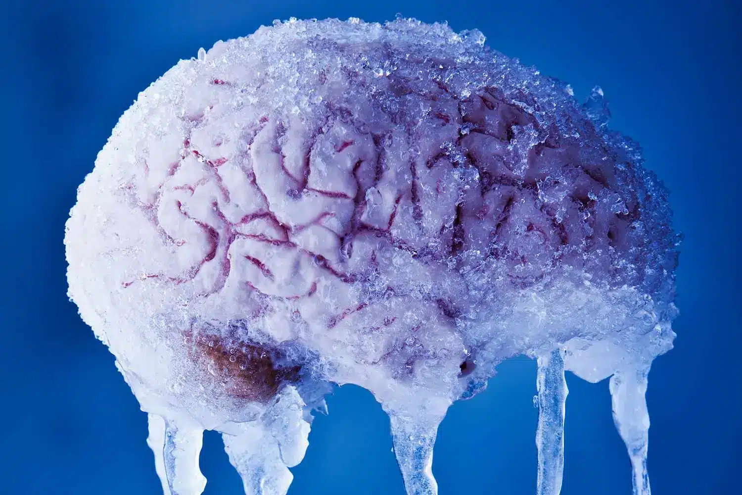 Ganglioneuralgia Esfenopalatina O Congelamento do Cerebro