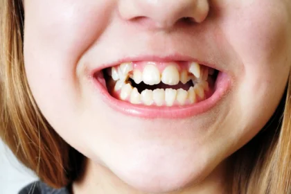 Por que os dentes não são considerados ossos