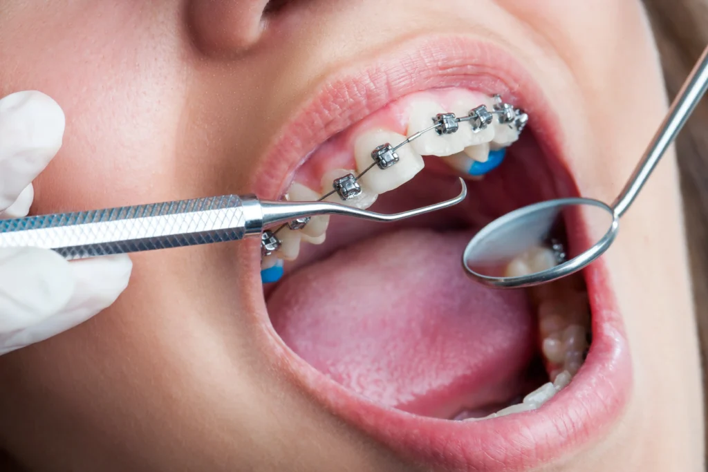 Parar de escovar os dentes pode tornar a sua boca o lugar perfeito para bacterias